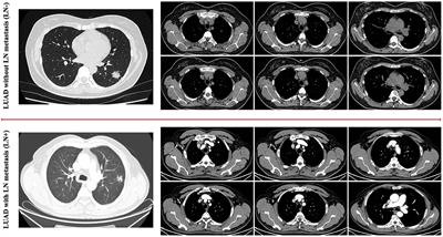 Cost-Sensitive Uncertainty Hypergraph Learning for Identification of Lymph Node Involvement With CT Imaging